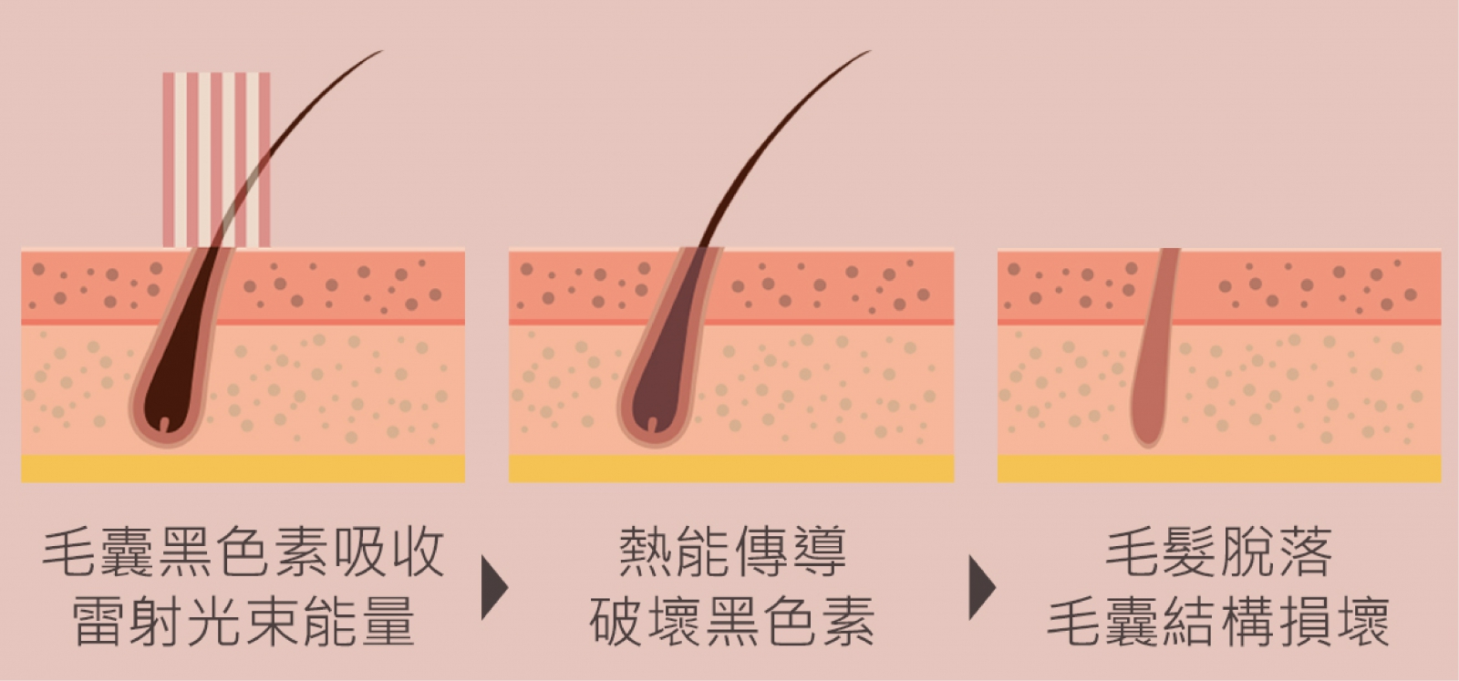 雷射除毛原理